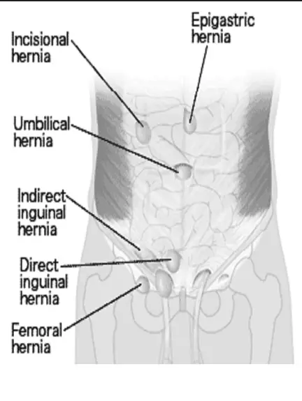 External Hernia